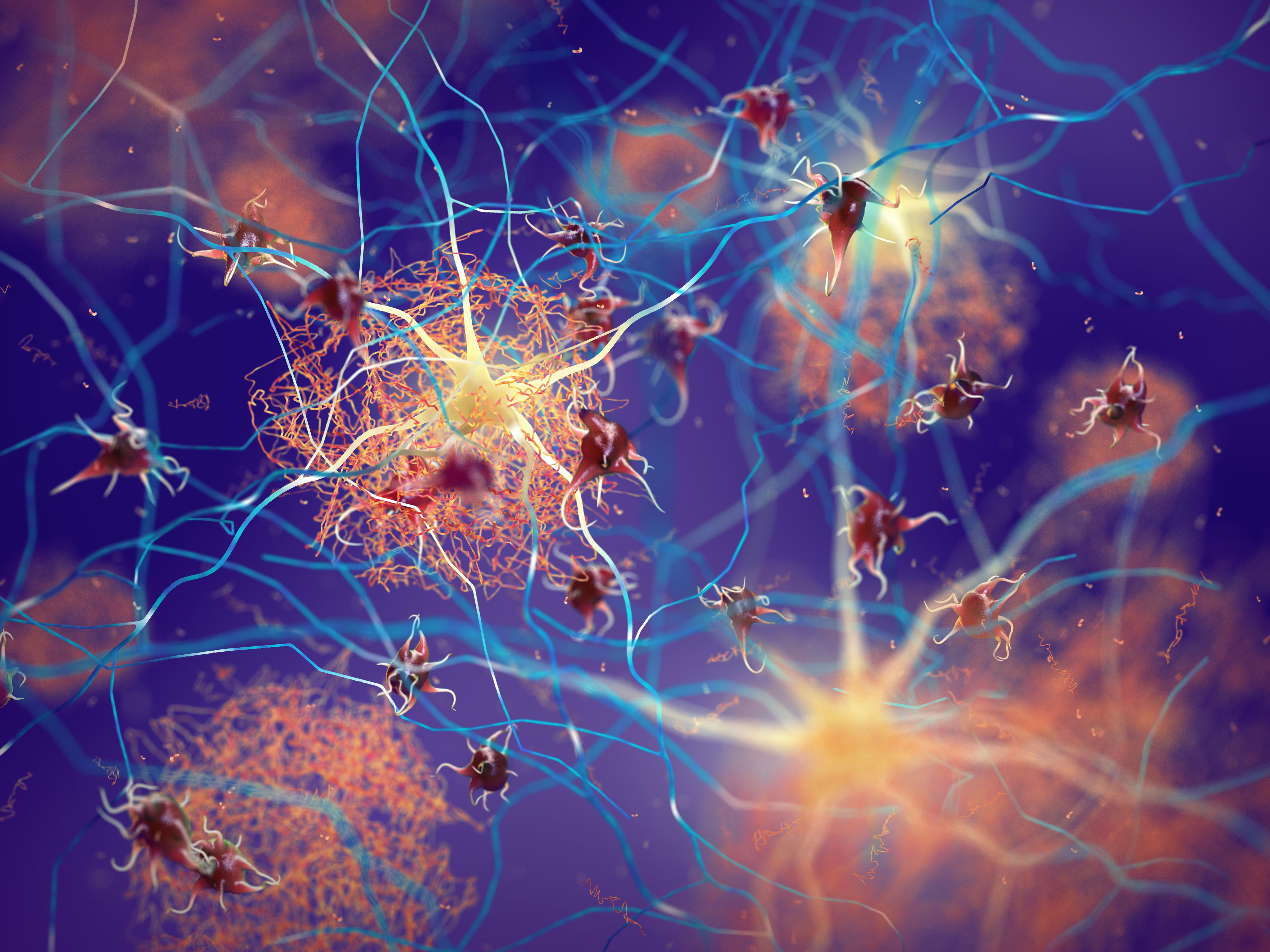 Placas amiloides formándose entre neuronas