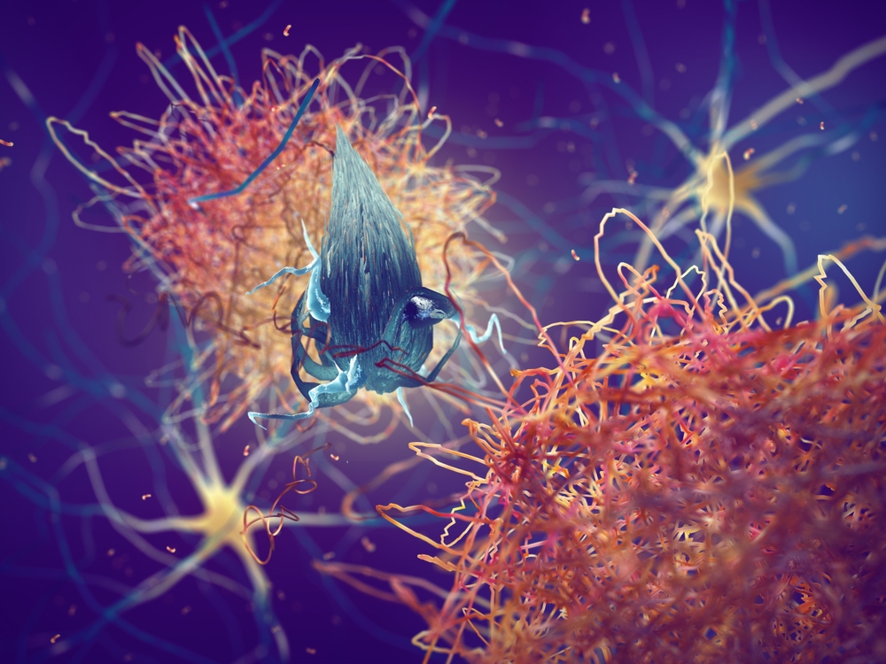 Placas amiloides formándose entre neuronas