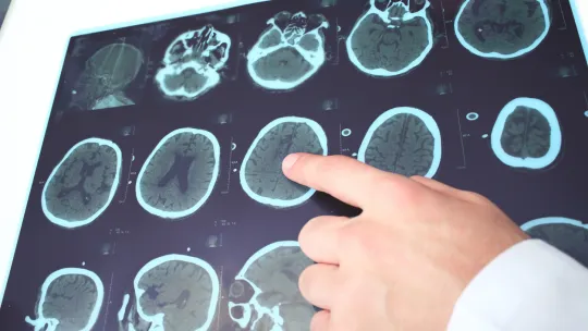 fases-del-Alzheimer.jpg fases-del-Alzheimer.jpg