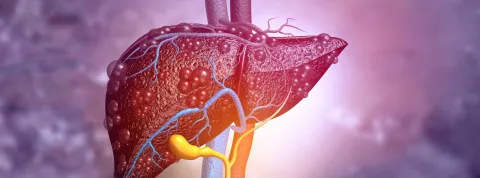 Representación 3D Hígado graso