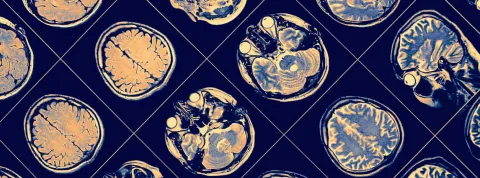 Parkinson y neuropsicología.jpg