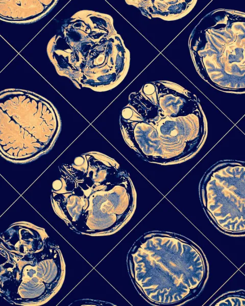 Parkinson y neuropsicología.jpg