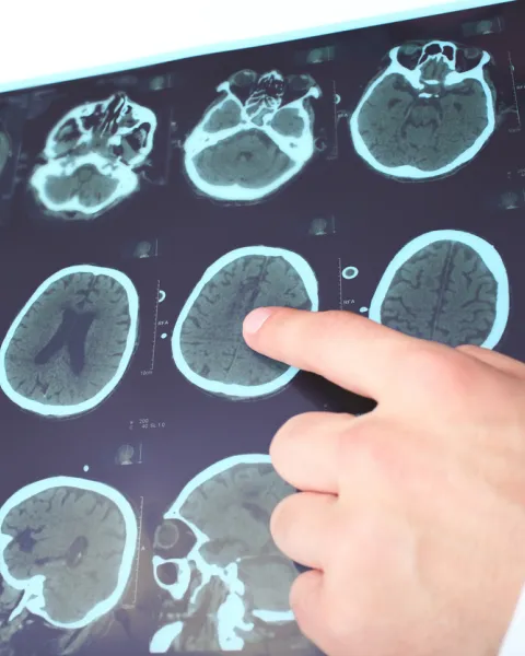fases-del-Alzheimer.jpg
